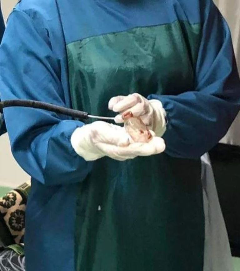 الزجاجة داخل قولون المريض