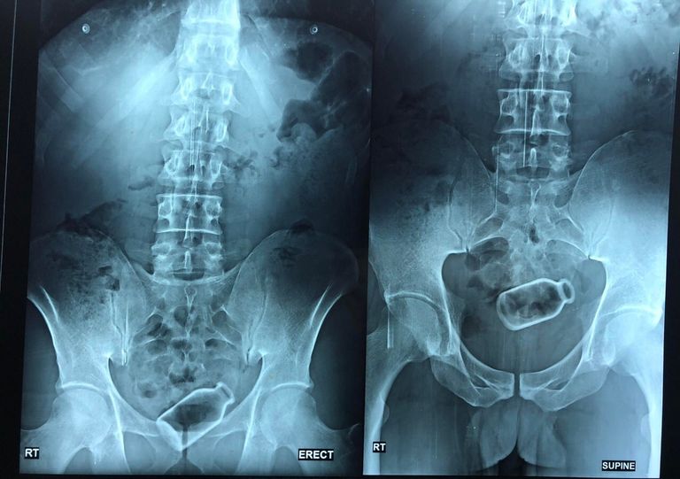 الزجاجة داخل قولون المريض