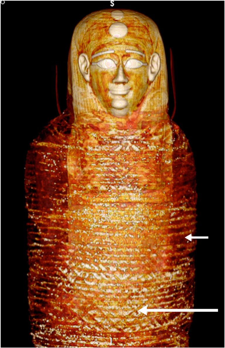 مومياء الصبي تحت الأشعة المقطعية