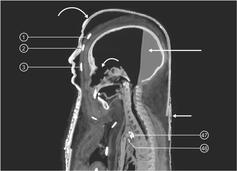 مومياء الصبي تحت الأشعة المقطعية