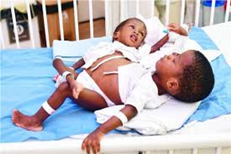 التوأم السيامي حسن وحسين