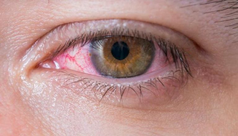 مصابة بالعين الوردية - صورة أرشيفية