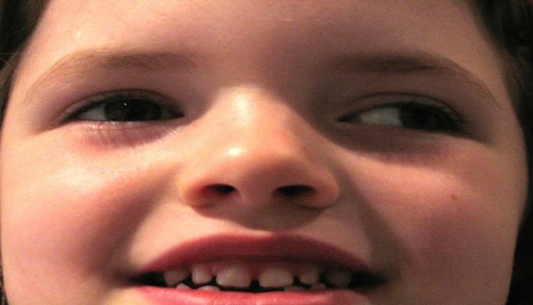 حول وحشي (Exotropia) نوع من أنواع الحول عند الأطفال - المصدر: westmeadeye