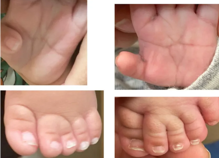 الأطفال الذين يعانون من المتلازمة لديهم رؤوس صغيرة