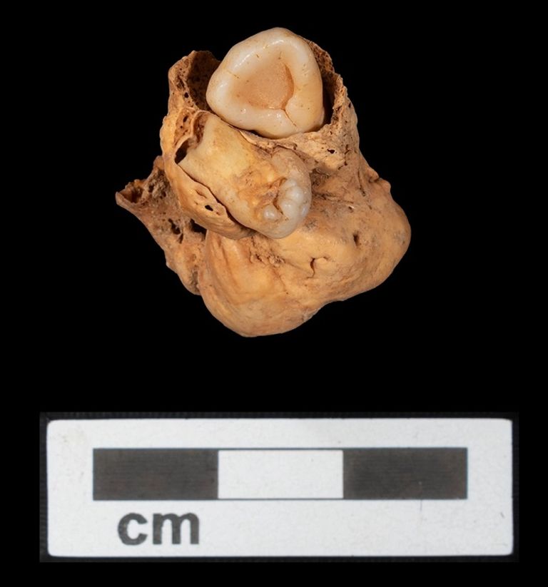 العينة التي تم اكتشاف الورم المسخي بها