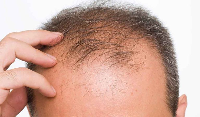 رجل يعاني الصلع - أرشيفية