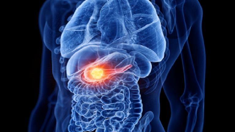 شخص مريض بمشاكل في البنكرياس- أرشيفية