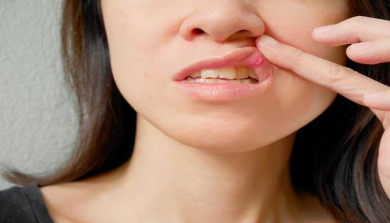أسباب فطريات الفم عند الكبار