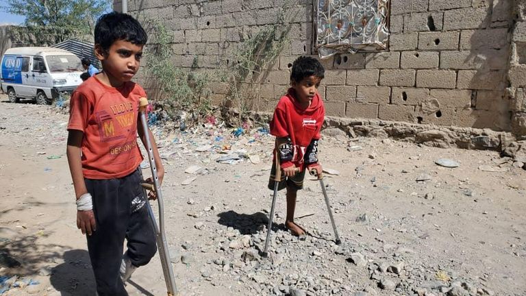 بدر ومحمد اللذان بترت أقدامهما بسبب قذيفة حوثية