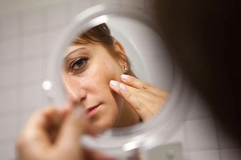  طرق فعالة لمواجهة البثور الهرمونية- أرشيفية