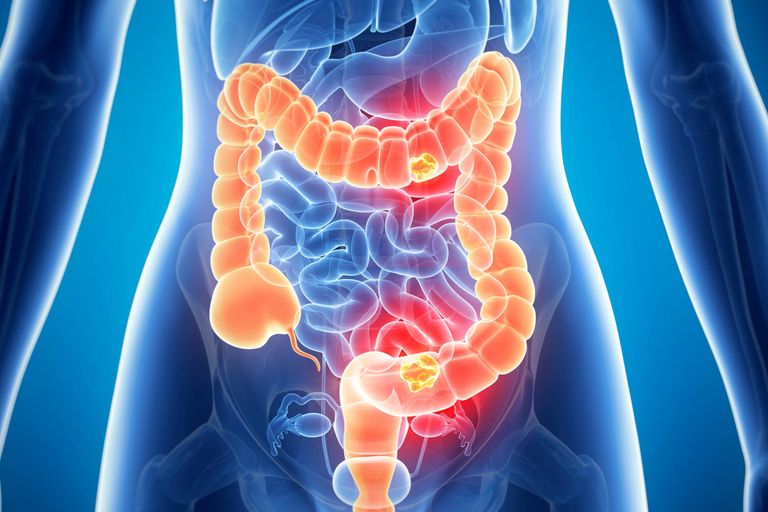 مارس شهر التوعية بسرطان القولون والمستقيم