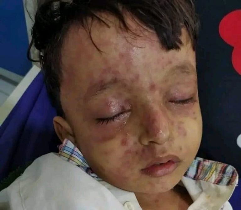 جريمة حوثية بحق أطفال اليمن.. منع اللقاحات يهدد 75 ألفا بالأوبئة