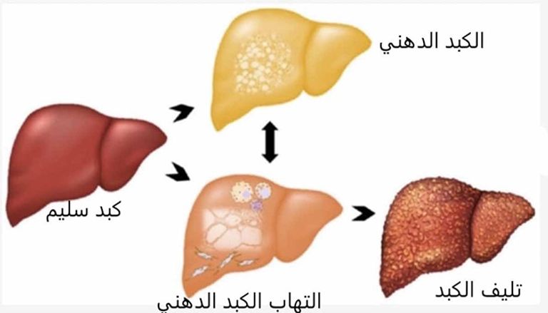مرضى الكبد والصيام في رمضان