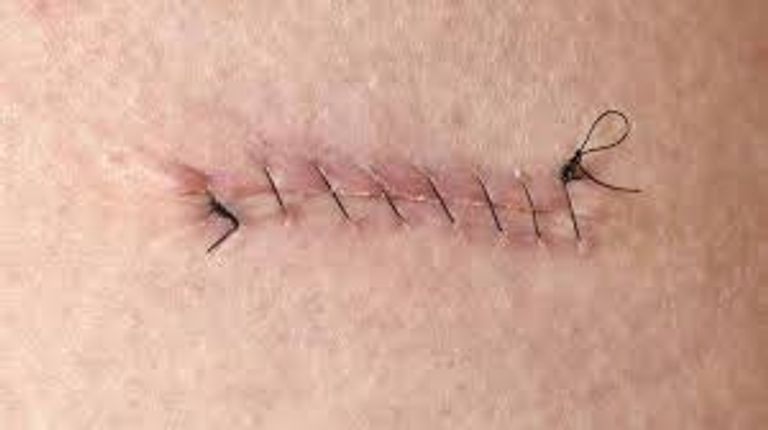 استخدام الكهرباء لعلاج الجروح