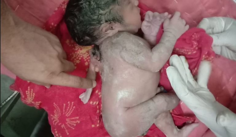 الطفل الهندي ولِد بطرف إضافي في ظهره