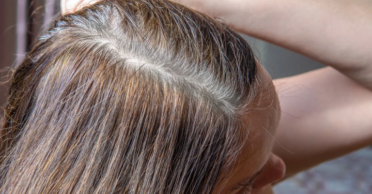 علاج نقص الميلانين في الشعر