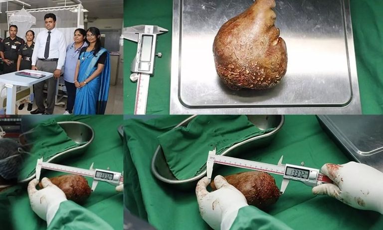 الحصوة الكلوية الأثقل في العالم