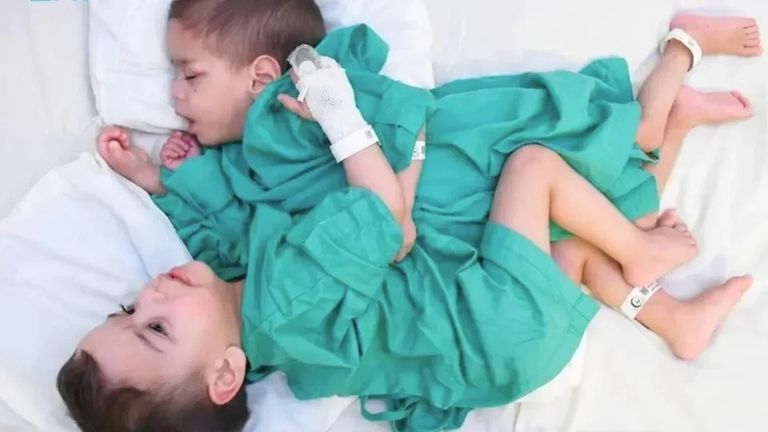 التوأم السيامي