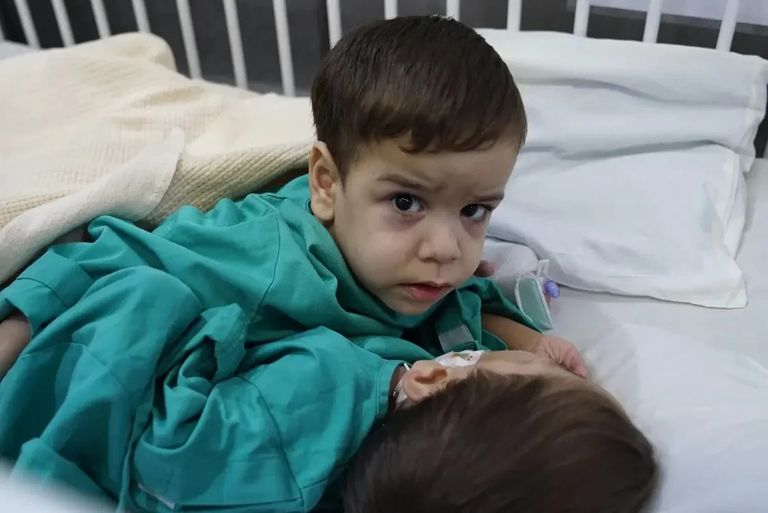 التوأم السيامي