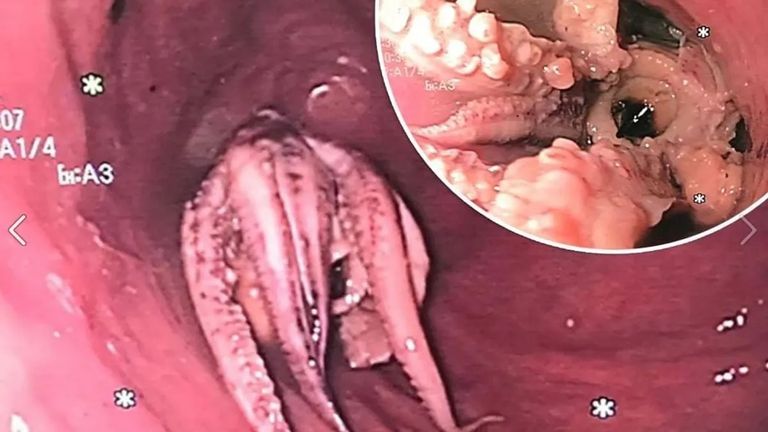 الأخطبوط ذو المجسات الثمانية