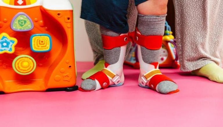 أسباب حنف القدم عند الأطفال