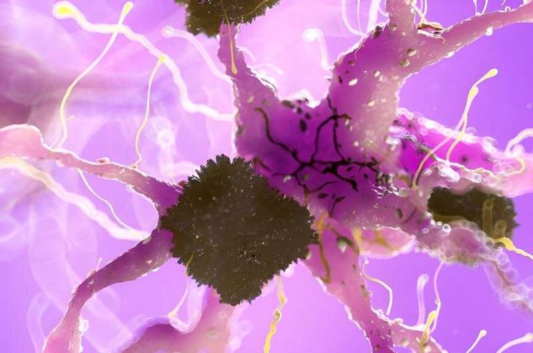 مريض بألزهايمر- أرشيفية