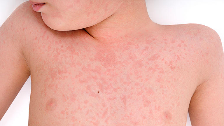 أمراض يتوقع انتشارها في 2024