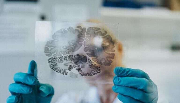 أشعة تكشف عن حالة دماغ شخص مصاب بأميبا الدماغ