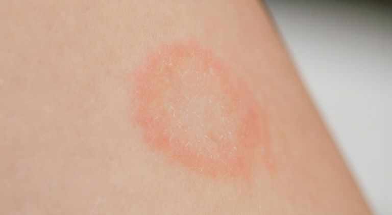 أشعة تكشف عن حالة دماغ شخص مصاب بأميبا الدماغ