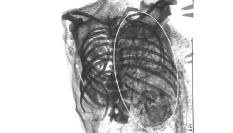 الباحثون عثروا على الجنين الثاني في تجويف الصدر