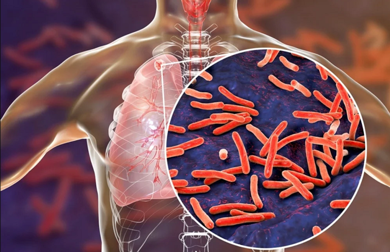 وفيات الأمراض الفطرية تتجاوز الوفيات الناجمة عن مسببات الأمراض الفردية