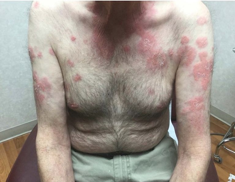 أعراض متلازمة فيكساس تتشابه مع أعراض لأمراض أخرى