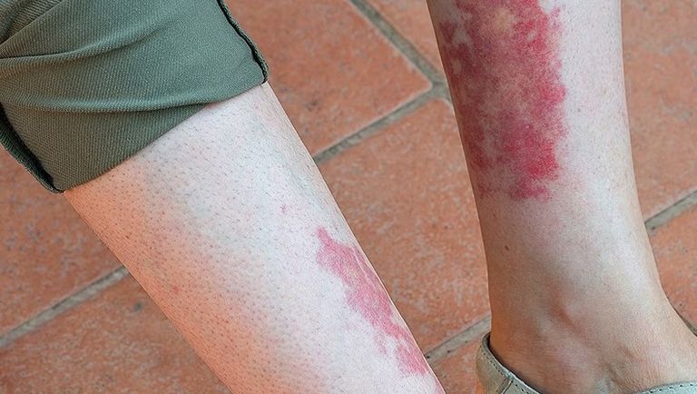 أعراض متلازمة فيكساس تتشابه مع أعراض لأمراض أخرى