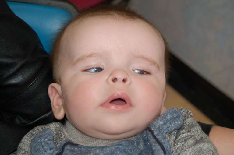 أحد الأطفال الذين شملتهم الدراسة يعاني من تضخم محيط الرأس أحد الأطفال الذين شملتهم الدراسة تظهر إصبعا إضافيا