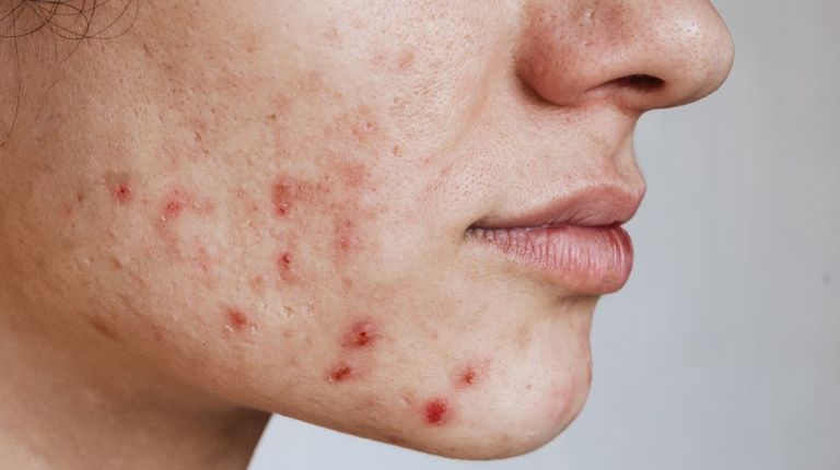 مراهقة تعاني من حب الشباب