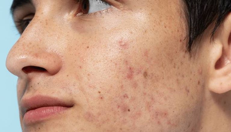 هل الشمس حقًا علاج لحب الشباب؟ هل الشمس حقًا علاج لحب الشباب؟