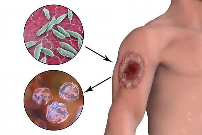 الليشمانيا ينتقل إلى البشر عبر لدغات إناث ذبابة الرمل