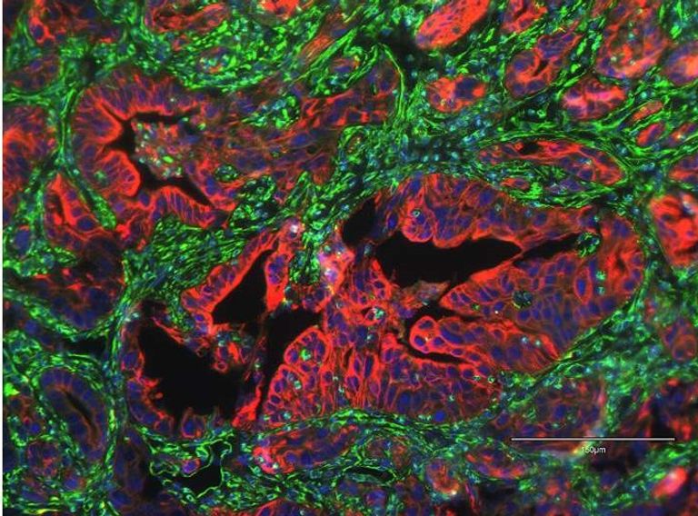 سرطان البنكرياس السبب الثالث للوفيات المرتبطة بالسرطان - تعبيرية