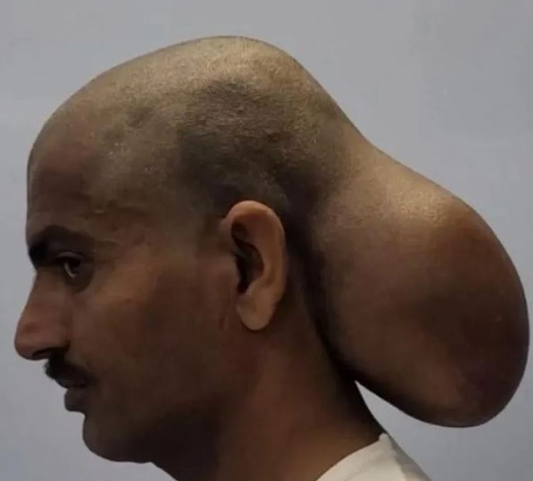 هذه الأورام تكون حميدة في معظمها