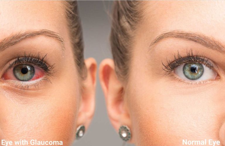 عين سيدة مصابة بالمرض