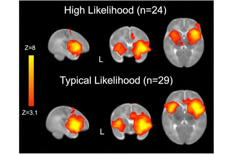 بصمة مميزة في أدمغة الأطفال المعرضين لخطر التوحد