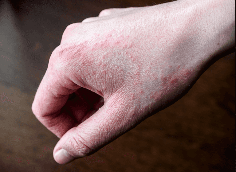 النساء يواجهن خطرا أكبر مقارنة بالرجال