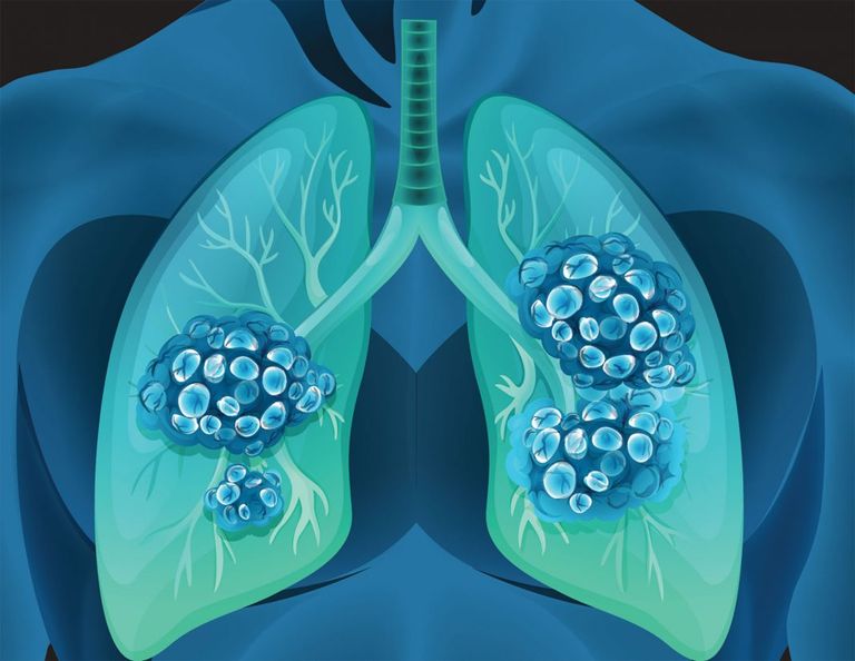الطريقة الجديد تمكن الجهاز المناعي من تحديد موقع الخلايا السرطانية 