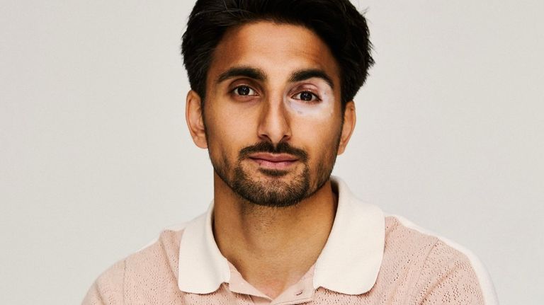 فتاة مصابة بالبهاق- أرشيفية