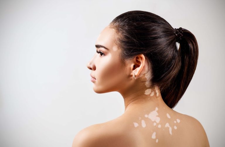 فتاة مصابة بالبهاق- أرشيفية