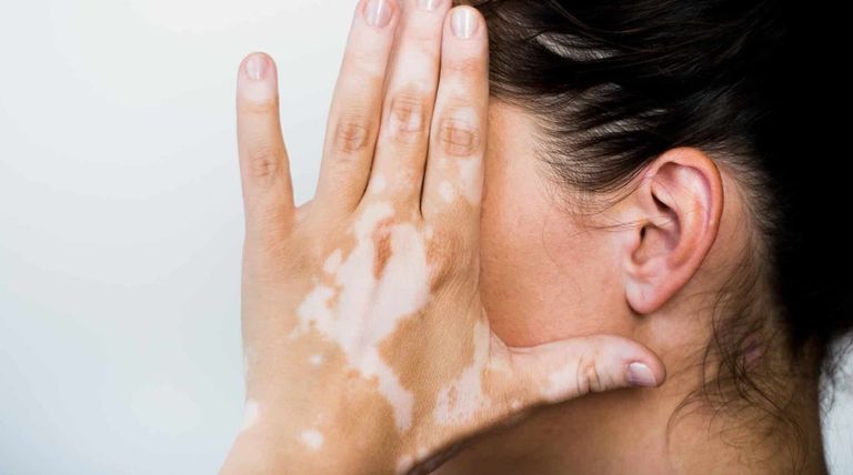 فتاة مصابة بالبهاق- أرشيفية