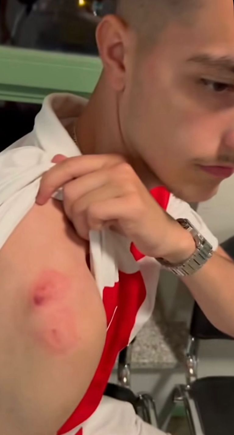 المشجع الكرواتي الذي تعرض للعض في يورو 2024 جماهير كرواتيا في مدرجات يورو 2024