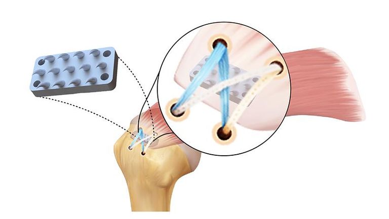 الجهاز الجديد مستوحى من أسنان الثعبان