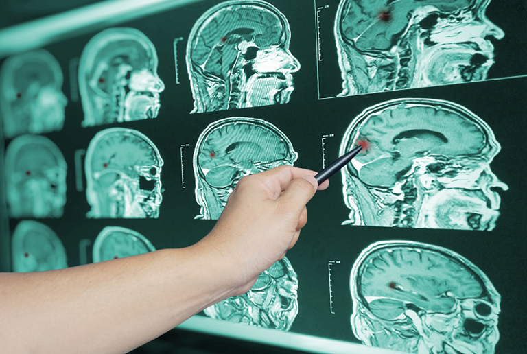 تكنولوجيا التصوير العصبي المتقدمة يمكنها قراءة أفكار مرضى الغيبوبة