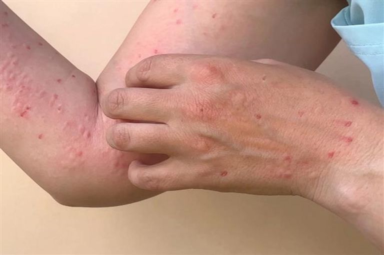 إصابة بجدري القرود - وكالات